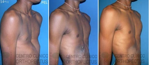 Orthopectus-Transfomartion-Flare-Ribs