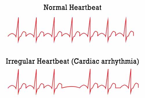irregular heart beat and inverted chest