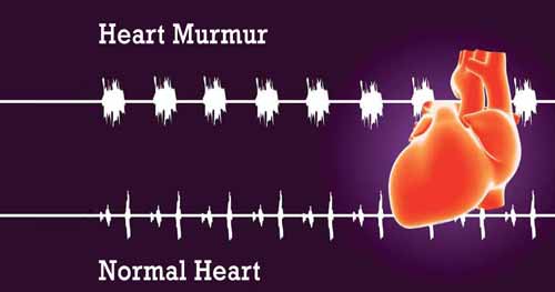 heart murmur and concave chest